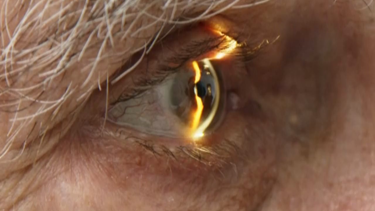 Cataracte : 5 causes de perte de vision à connaître !