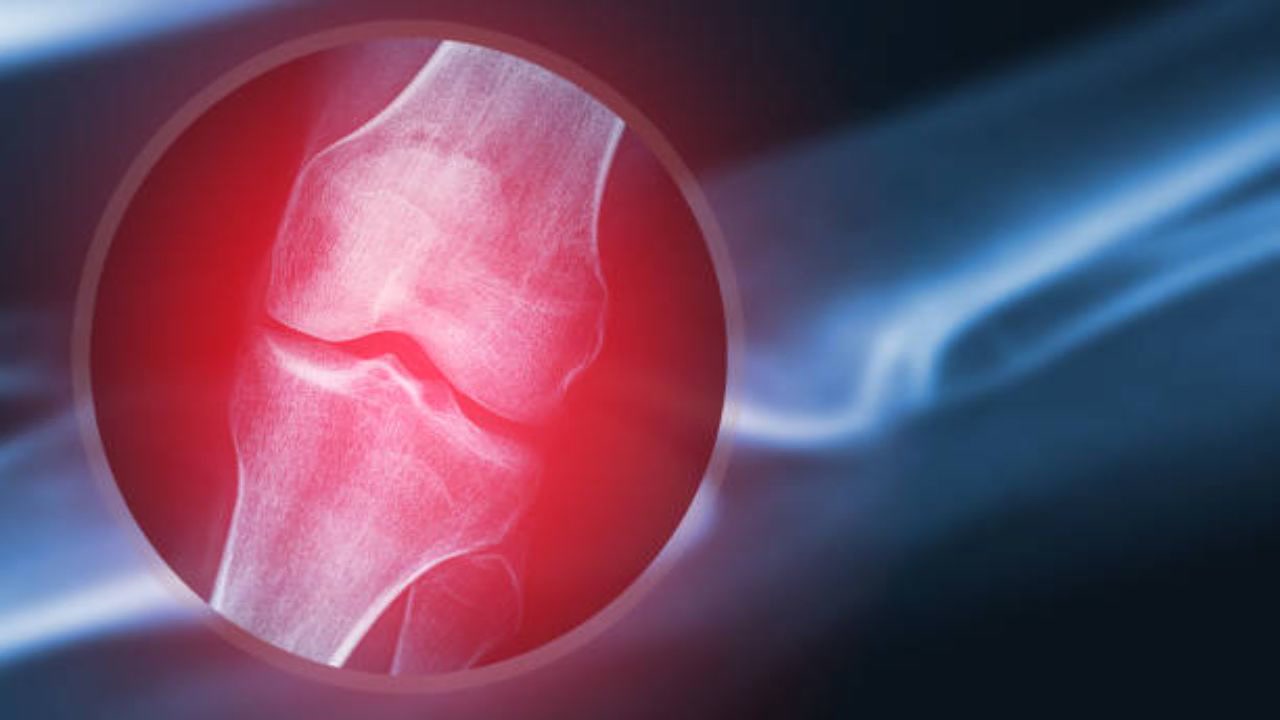 Comprendre l'arthrose du genou en 5 minutes!